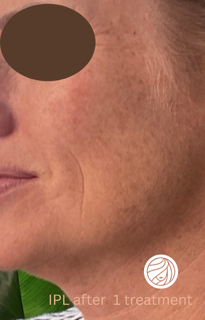 Face of a woman after IPL treatment. Dark spots and wrinkles reduced; skin appears smoother.