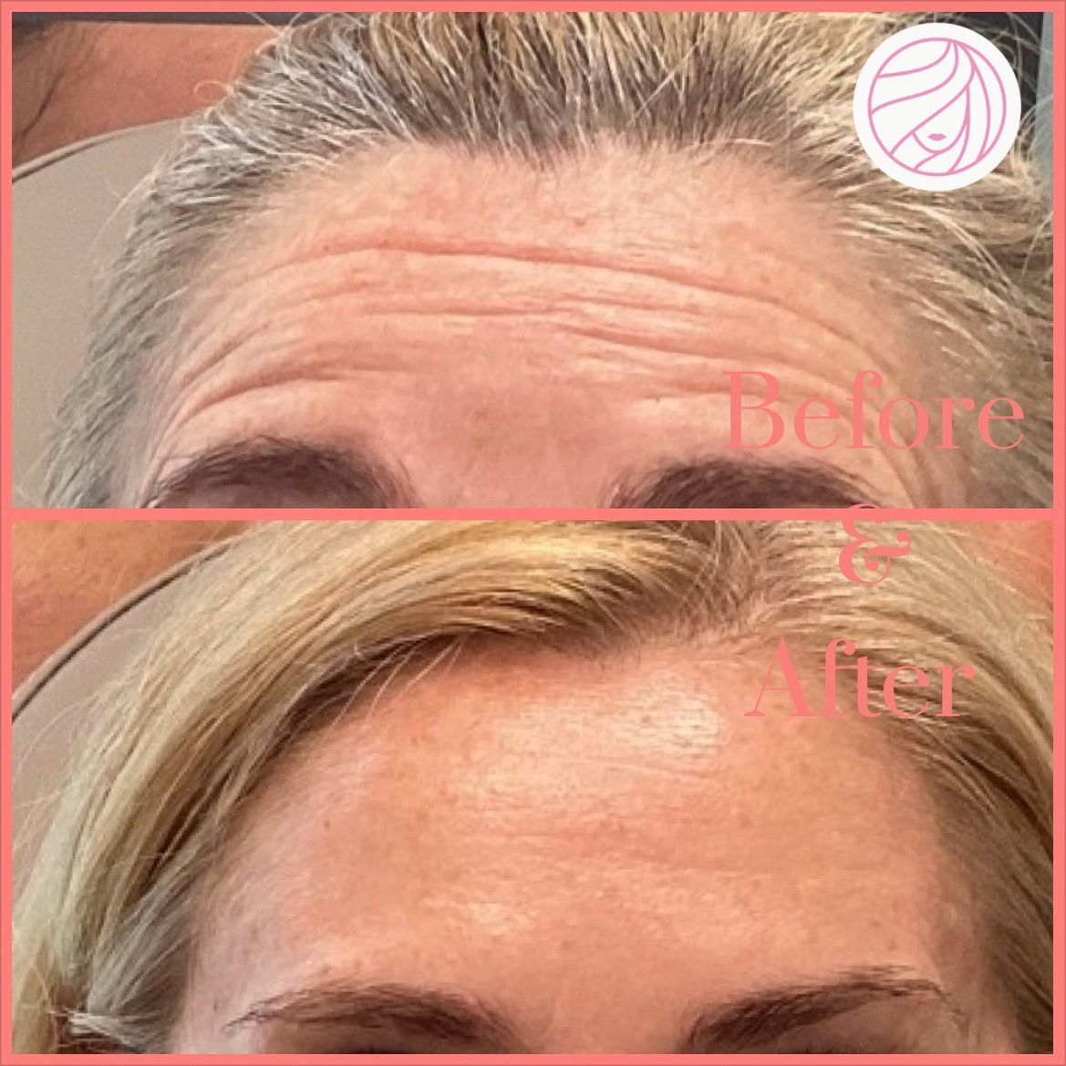 Before/after comparison of forehead wrinkles: top is wrinkled, bottom is smooth.