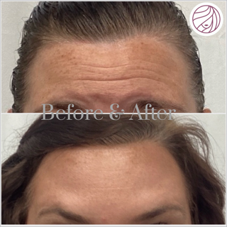 Before and after comparison: A person's forehead with visible wrinkles reduced after treatment.