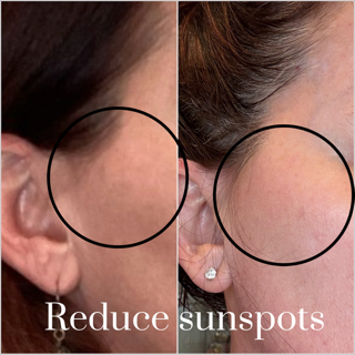 Side-by-side photos of a woman's face show sunspot reduction; the right side has fewer spots.