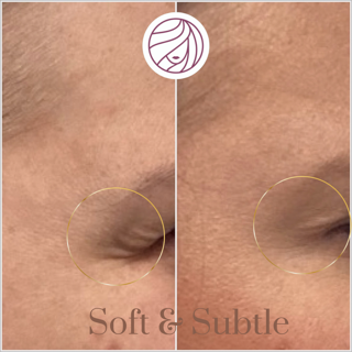 Wrinkles around eye before and after treatment, skin appears smoother on the right.