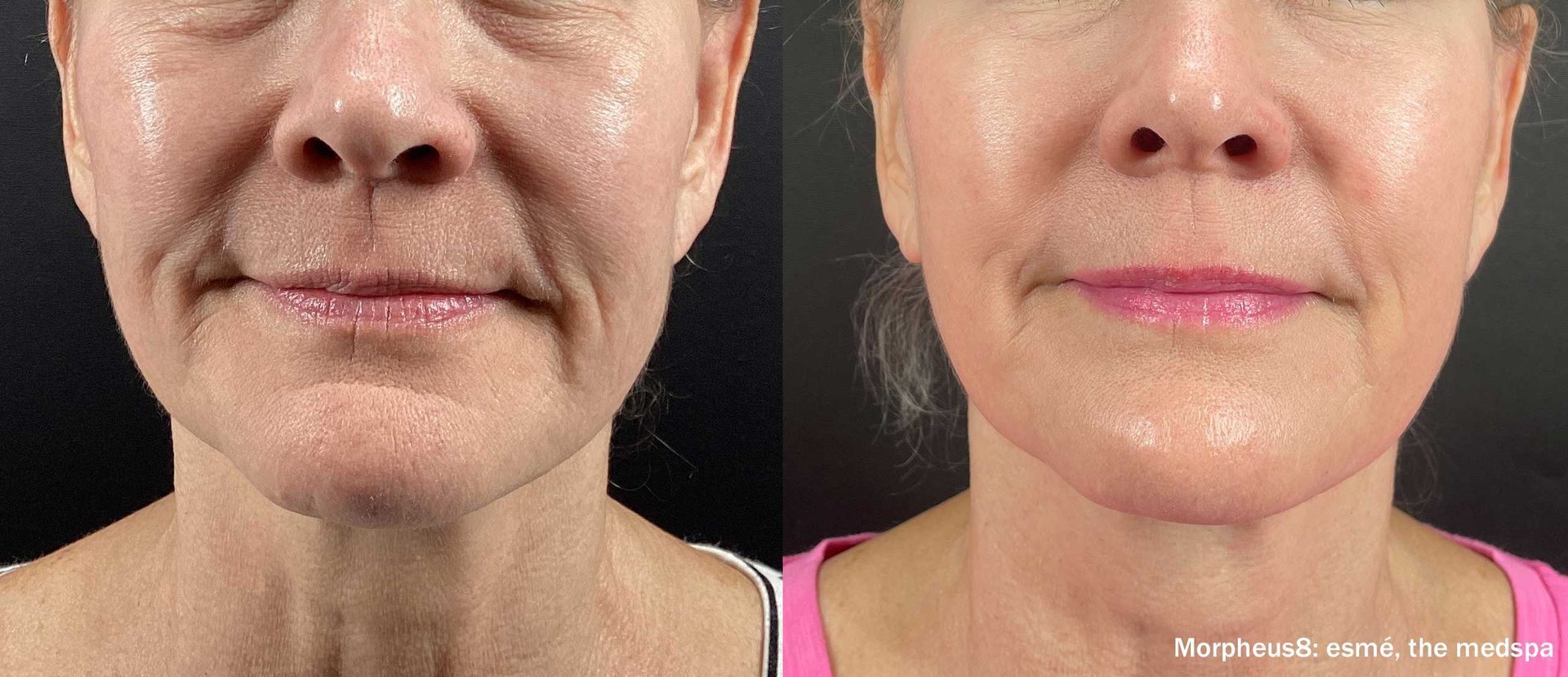 Side-by-side view of a woman's face before and after a cosmetic procedure. The 