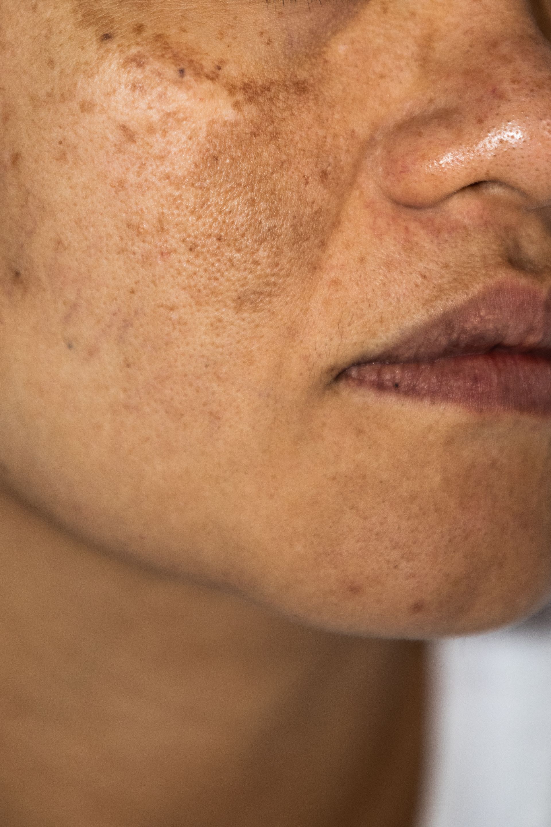 Close-up of a face with brown freckles and skin spots, showing the cheek, nose, and lips.