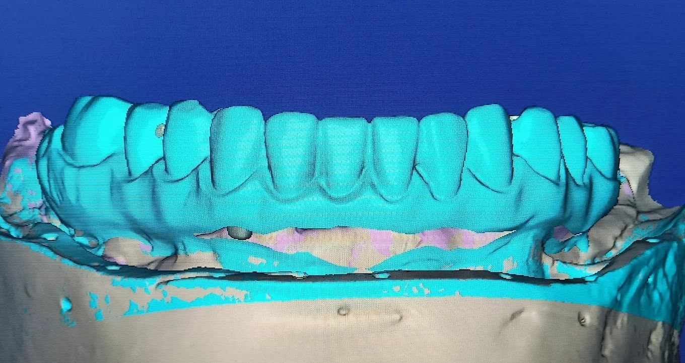 realizzazione protesi 14