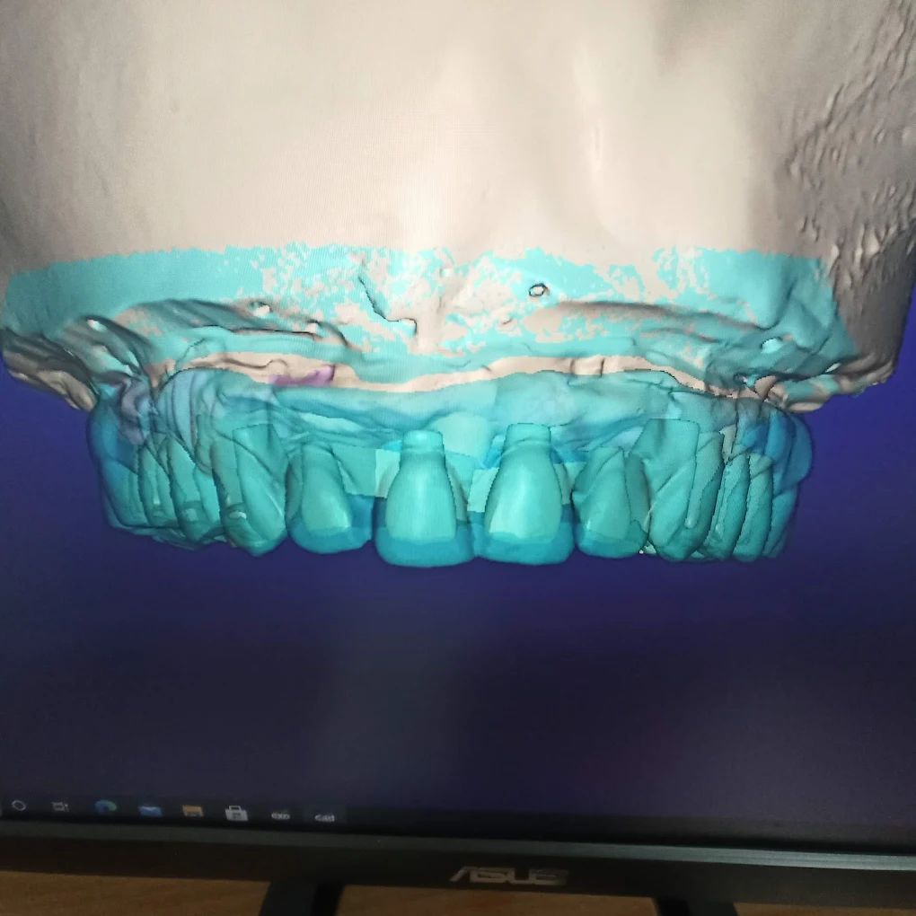 realizzazione protesi 09