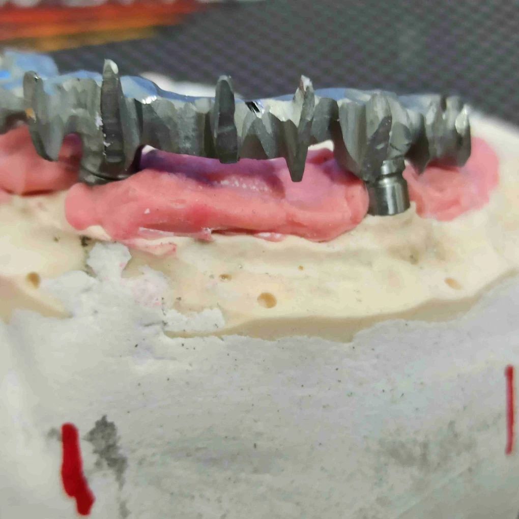 realizzazione protesi 08