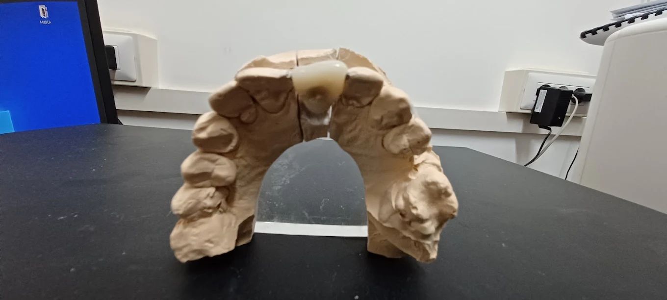 realizzazione protesi 05