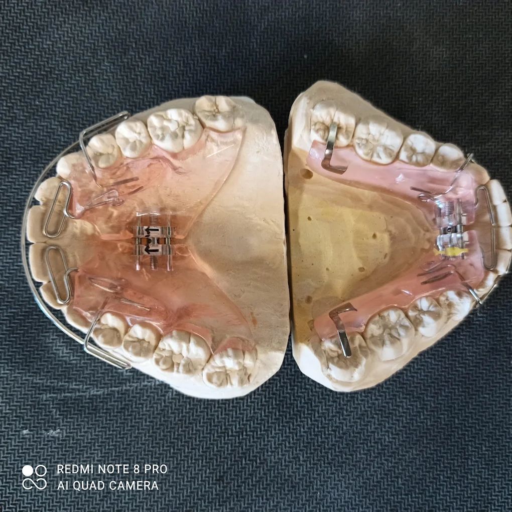 realizzazione protesi 02