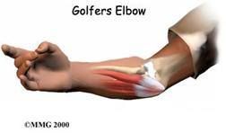 diagram of golfers elbow