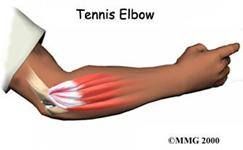 diagram of tennis elbow