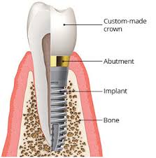 Implant 3—Dental Implant in Lake Wylie, SC