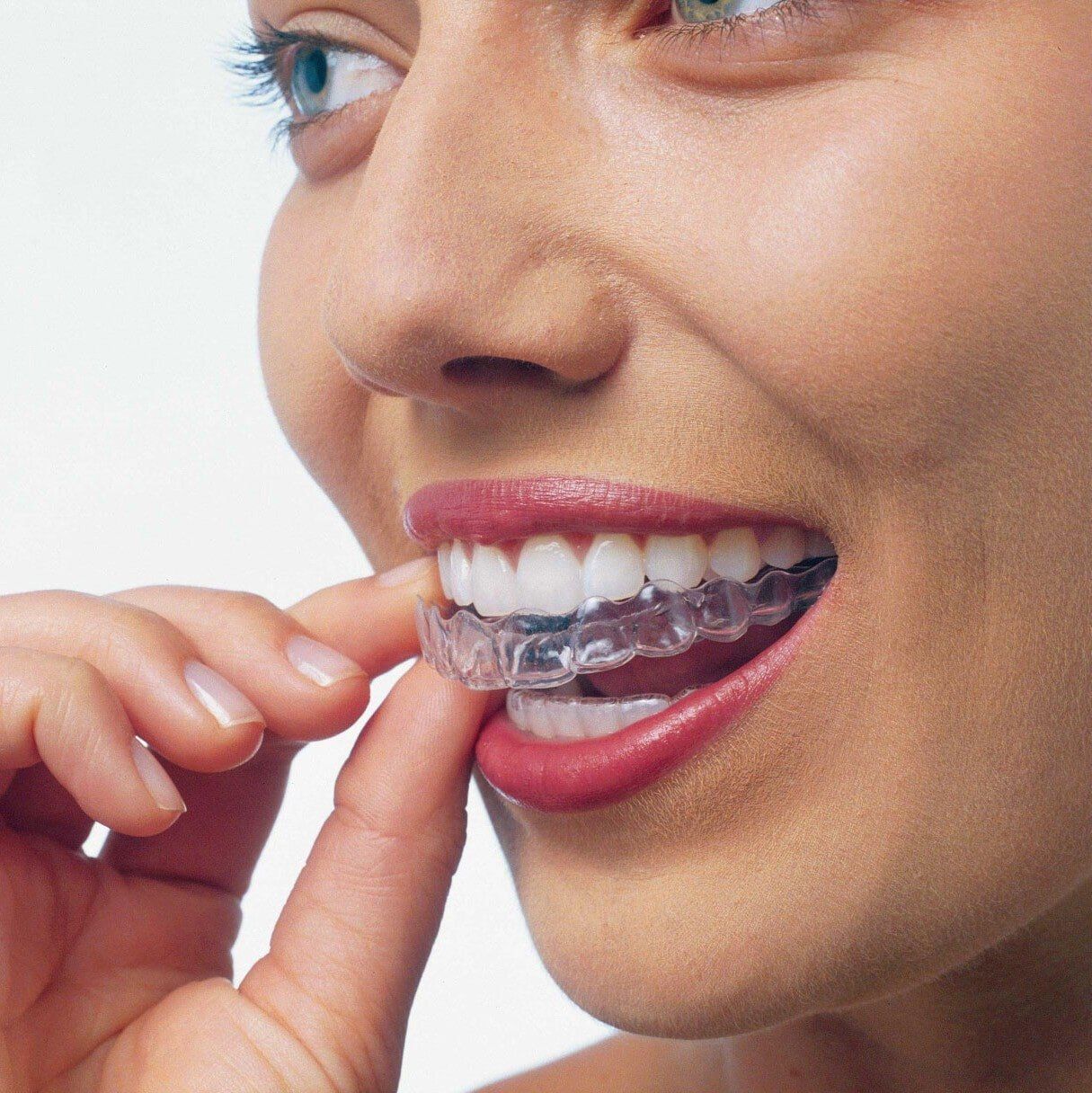 A Person Wearing Invisalign—Invisalign in Lake Wylie, SC