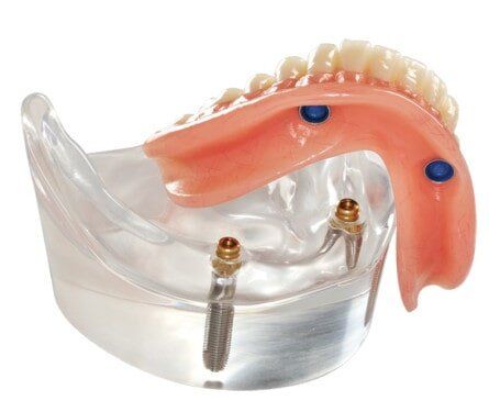 A Pair of Dentures—Restorative Dentistry in Lake Wylie, SC
