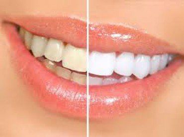 White Teeth—Cosmetic Dentistry in Lake Wylie, SC