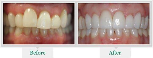 Yellowish Teeth And White Teeth —Dentist in Lake Wylie, SC