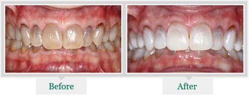 Before And After Cleaning The Teeth — Dentist in Lake Wylie, SC