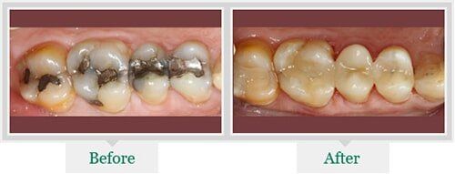 Unhealthy Teeth — Dentist in Lake Wylie, SC