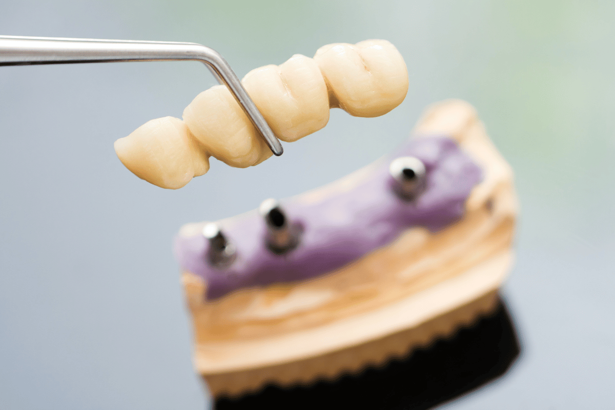 Dental bridge held with forceps, over a model with implant posts.