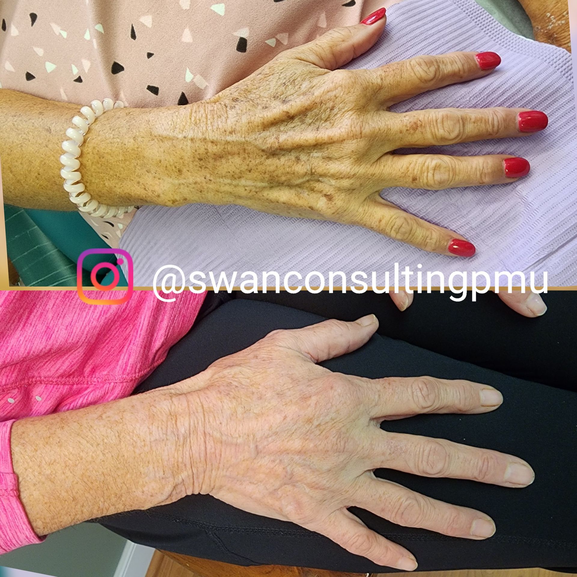 Two hands, top with red nails and bracelet, bottom with relaxed posture. Both are aged, showing age spots and wrinkles.
