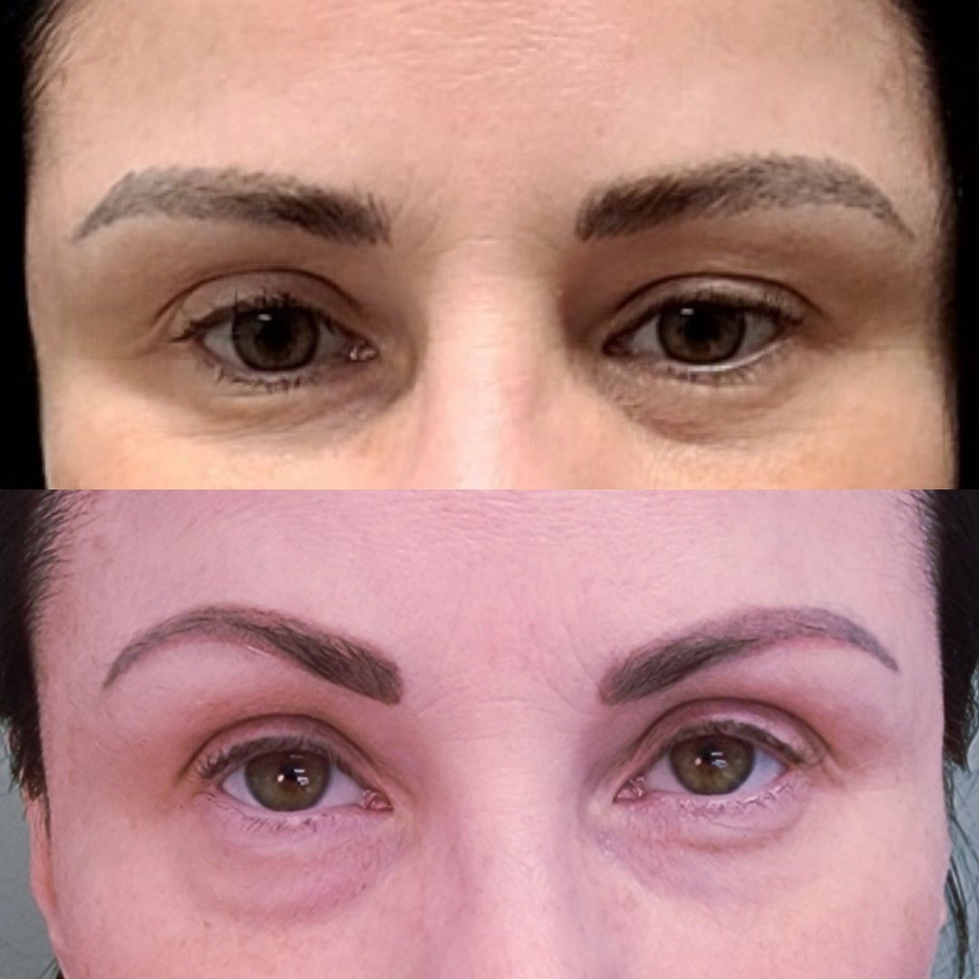 Before and after view of a person's eyes, showing reduced under-eye puffiness and smoother skin in the after image.