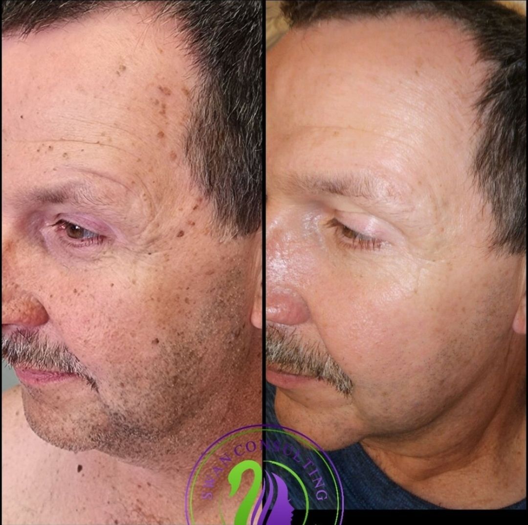 Side-by-side comparison of a man's face before and after a skin treatment, showing reduced age spots and wrinkles.