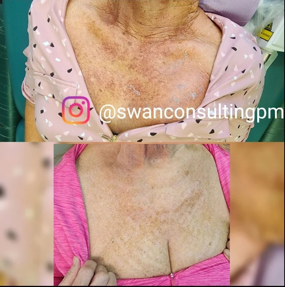Two photos showing a woman's chest before and after treatment, reducing sun damage and skin discoloration.