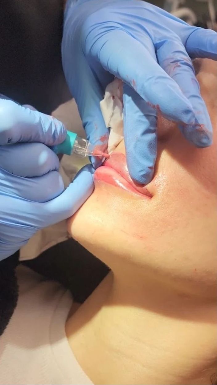 A person receives lip injections. Two gloved hands hold a syringe near the lips, with a tissue nearby.