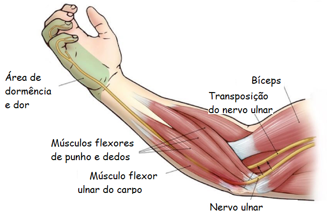 compressao-nervo-ulnar-dr-guilherme-noffs-ortopedista-cotovelo-sp