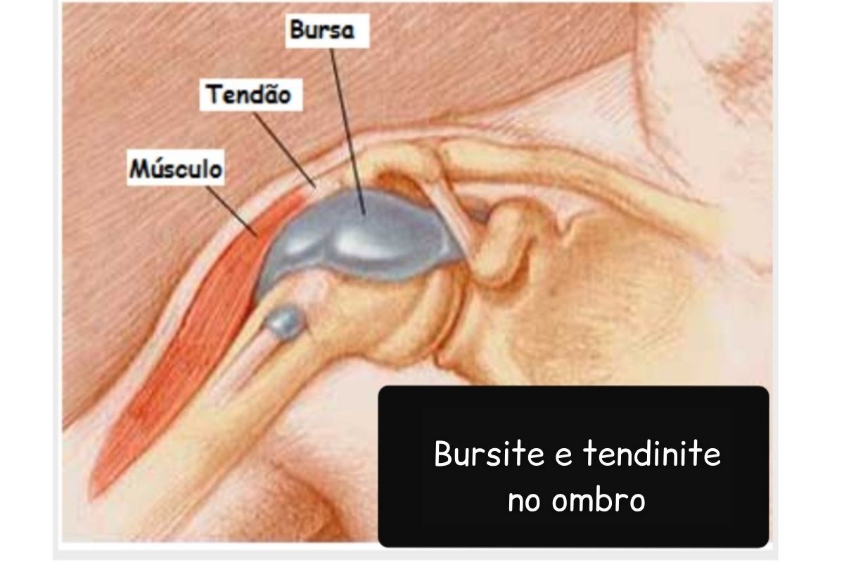 dr-guilherme-noffs-ortopedista-bursite-ombro