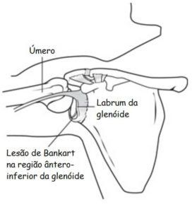 Um desenho em preto e branco do ombro de uma pessoa com as palavras labrrum da glenoide abaixo dele