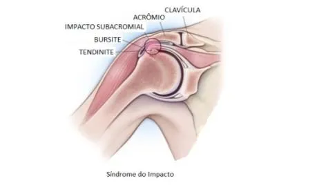 sindrome-do-impacto-dr-guilherme-noffs-ortopedista-são-paulo