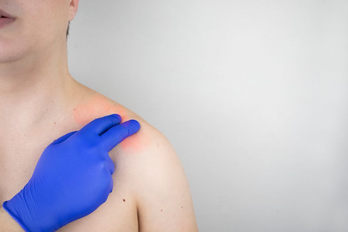 Tendinite calcária do ombro: saiba como identificar e tratar