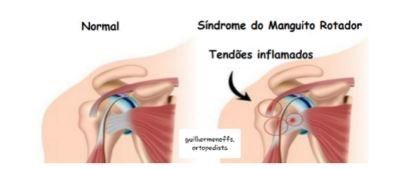 tendinite-ombro-dr-guilherme-noffs-ortopedista-ombro-sao-paulo