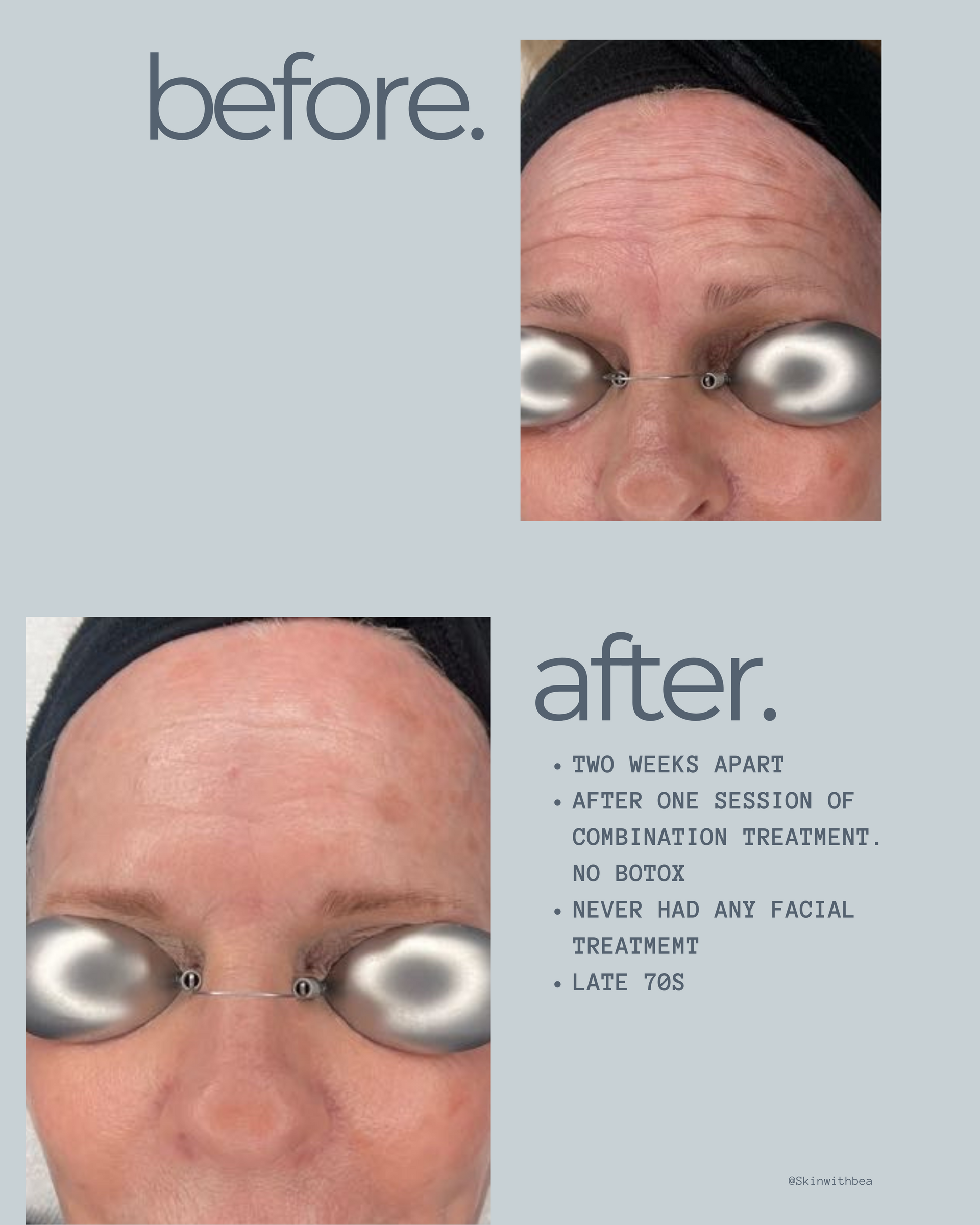 Anti aging treatment before and after