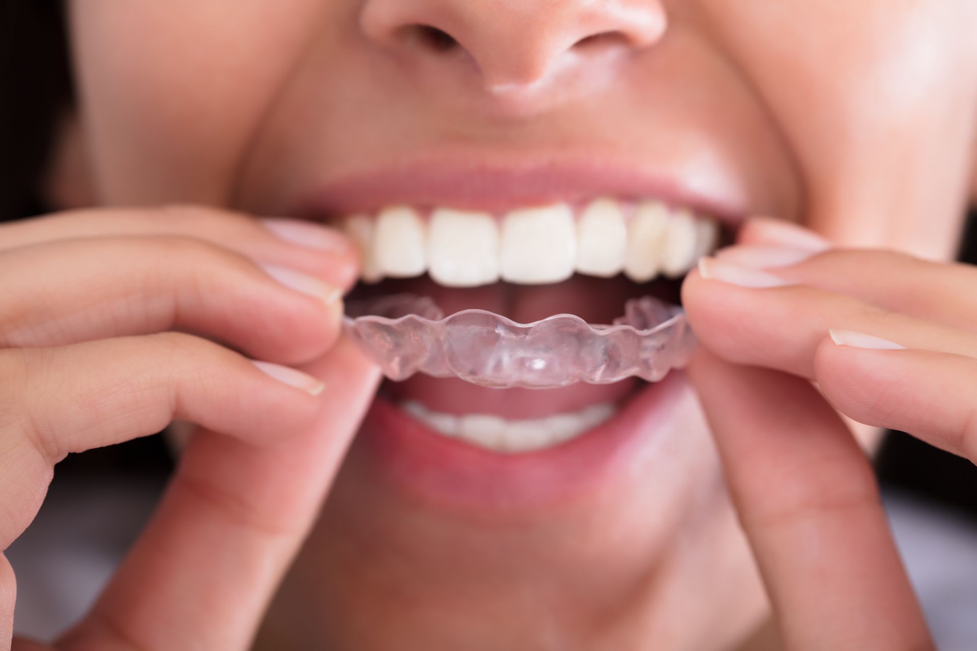 Clear aligners being applied