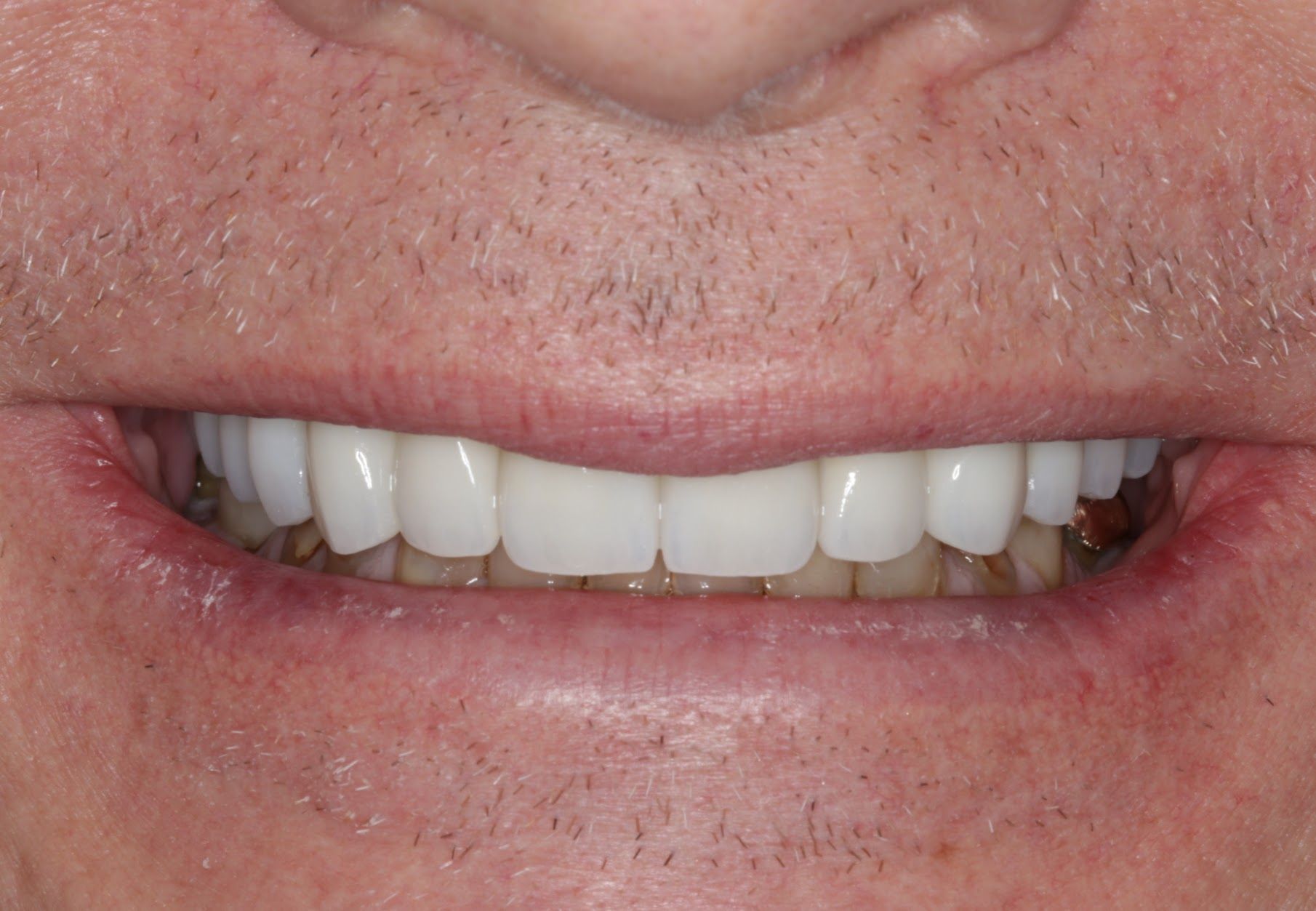 A close up of a man 's mouth with white teeth.