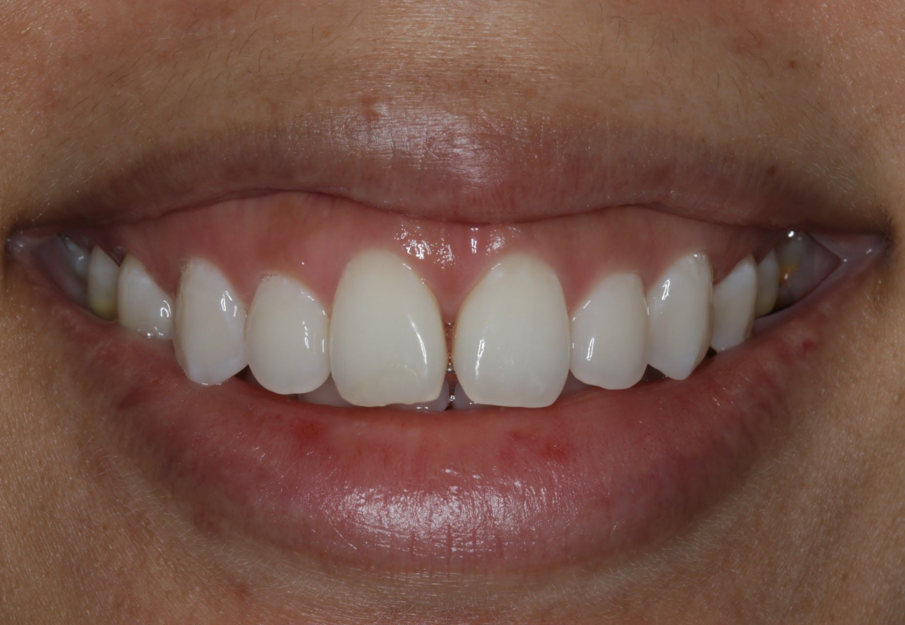 A close up of a woman 's mouth with white teeth.
