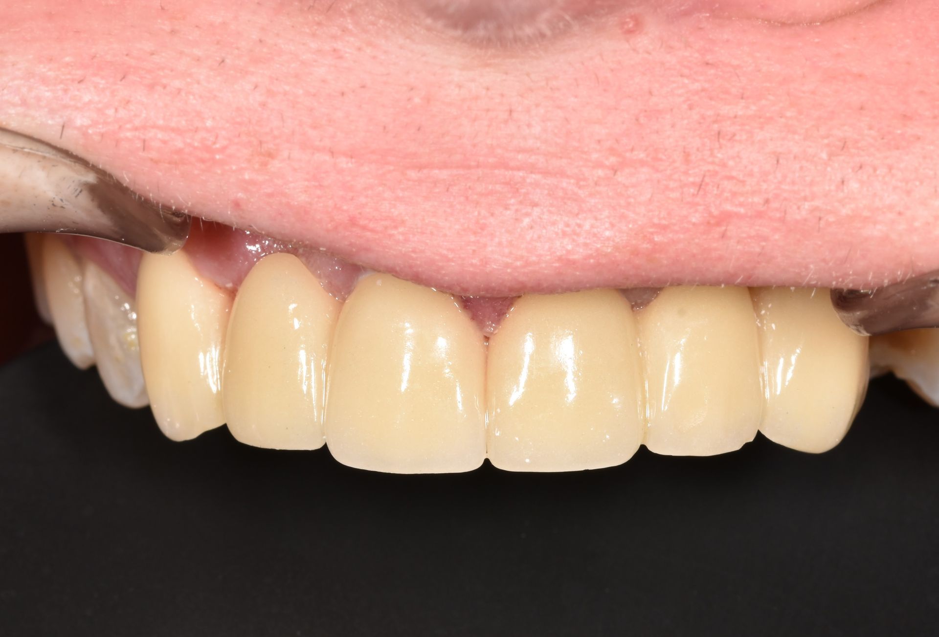 A close up of a person 's teeth with a black background.