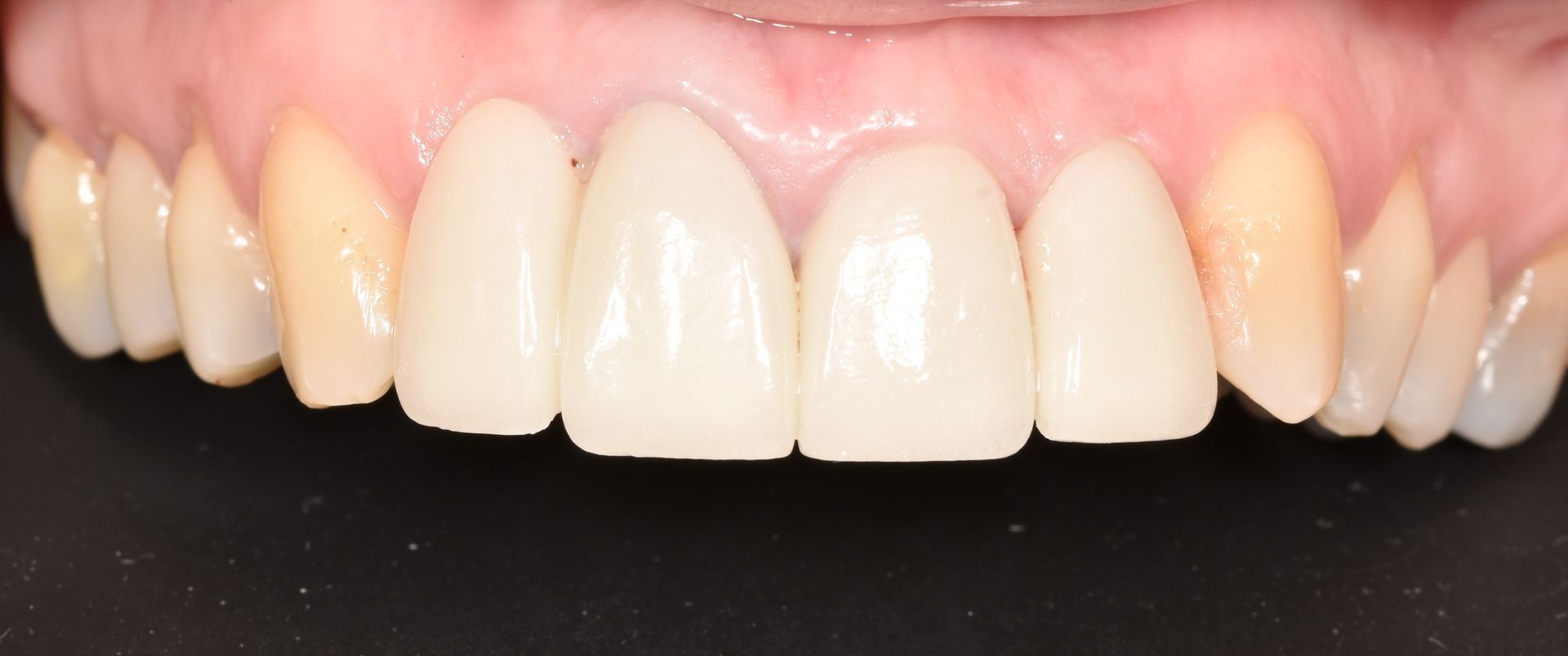 A close up of a person 's teeth with a black background.