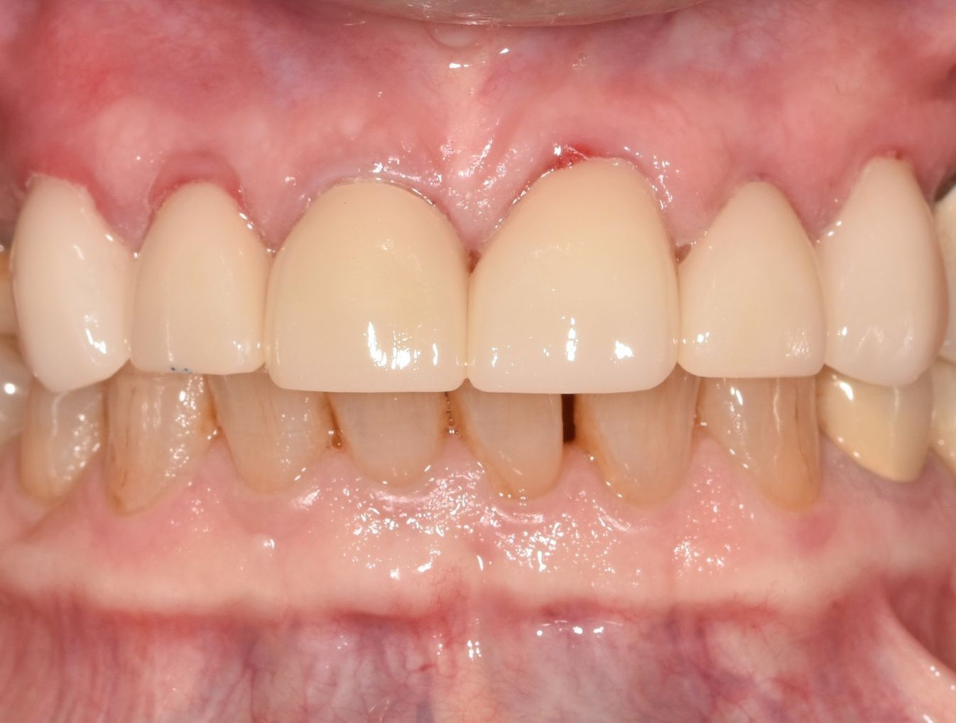 A close up of a person 's teeth with a missing tooth.