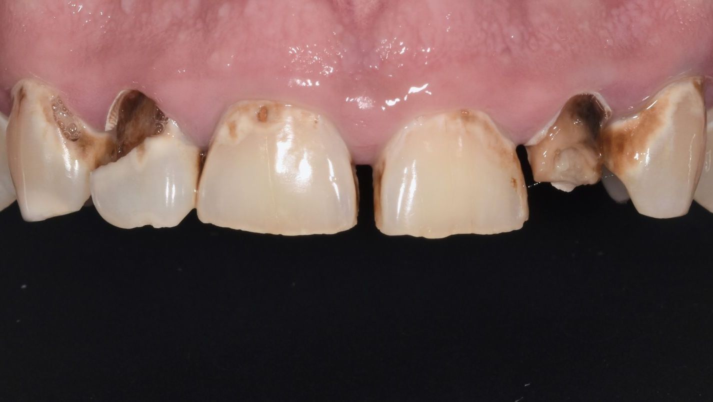 A close up of a person 's teeth with a black background.