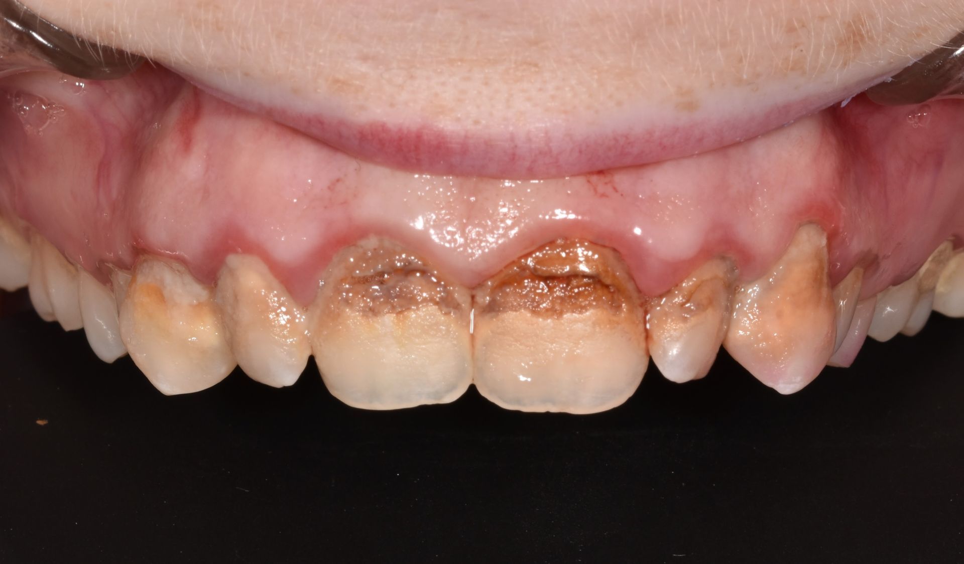 A close up of a person 's teeth with a black background.