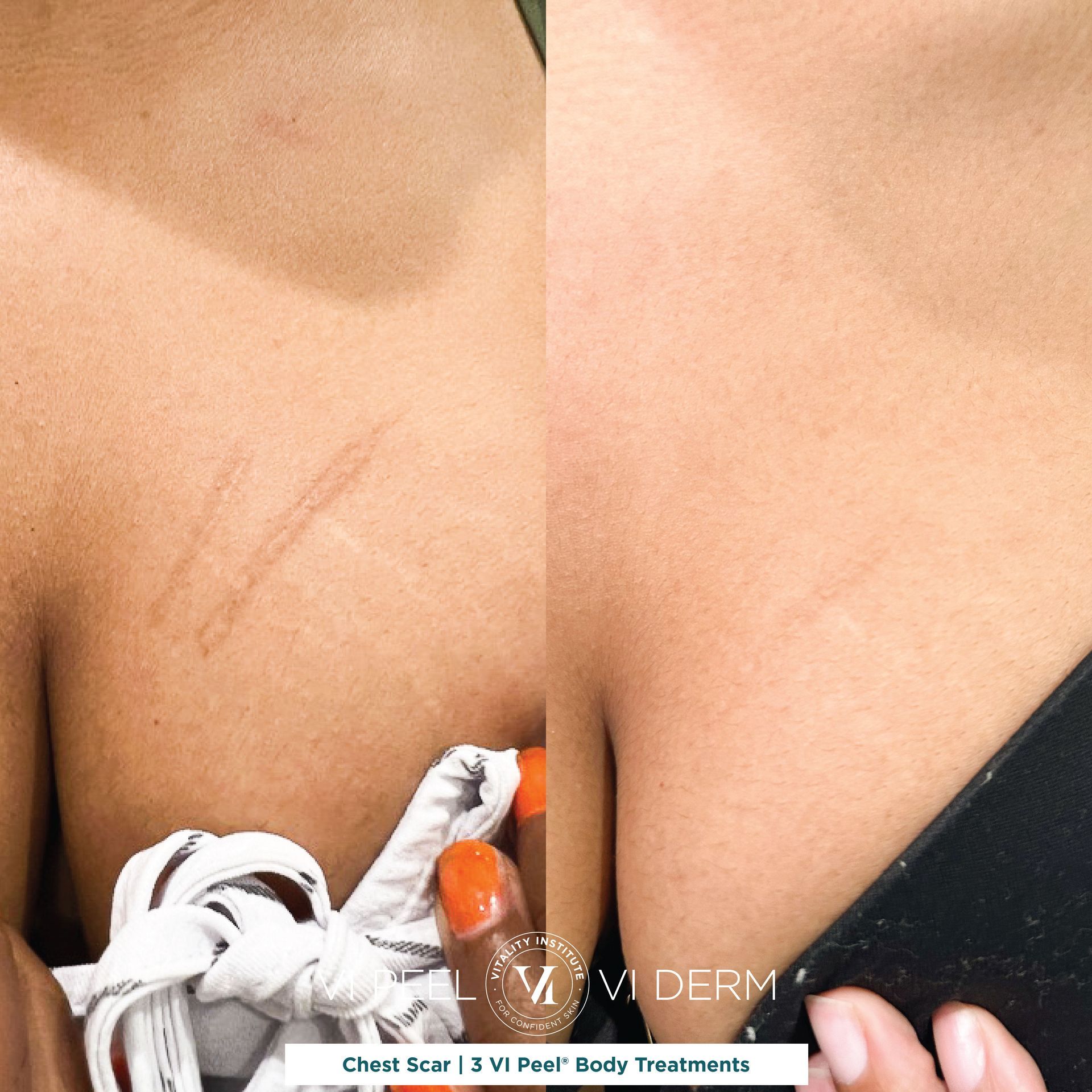 a before and after of scars on chest
