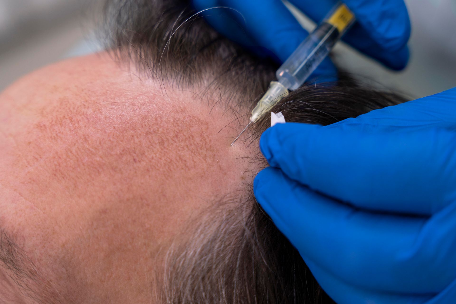 A close up of a person getting an injection in their hair.