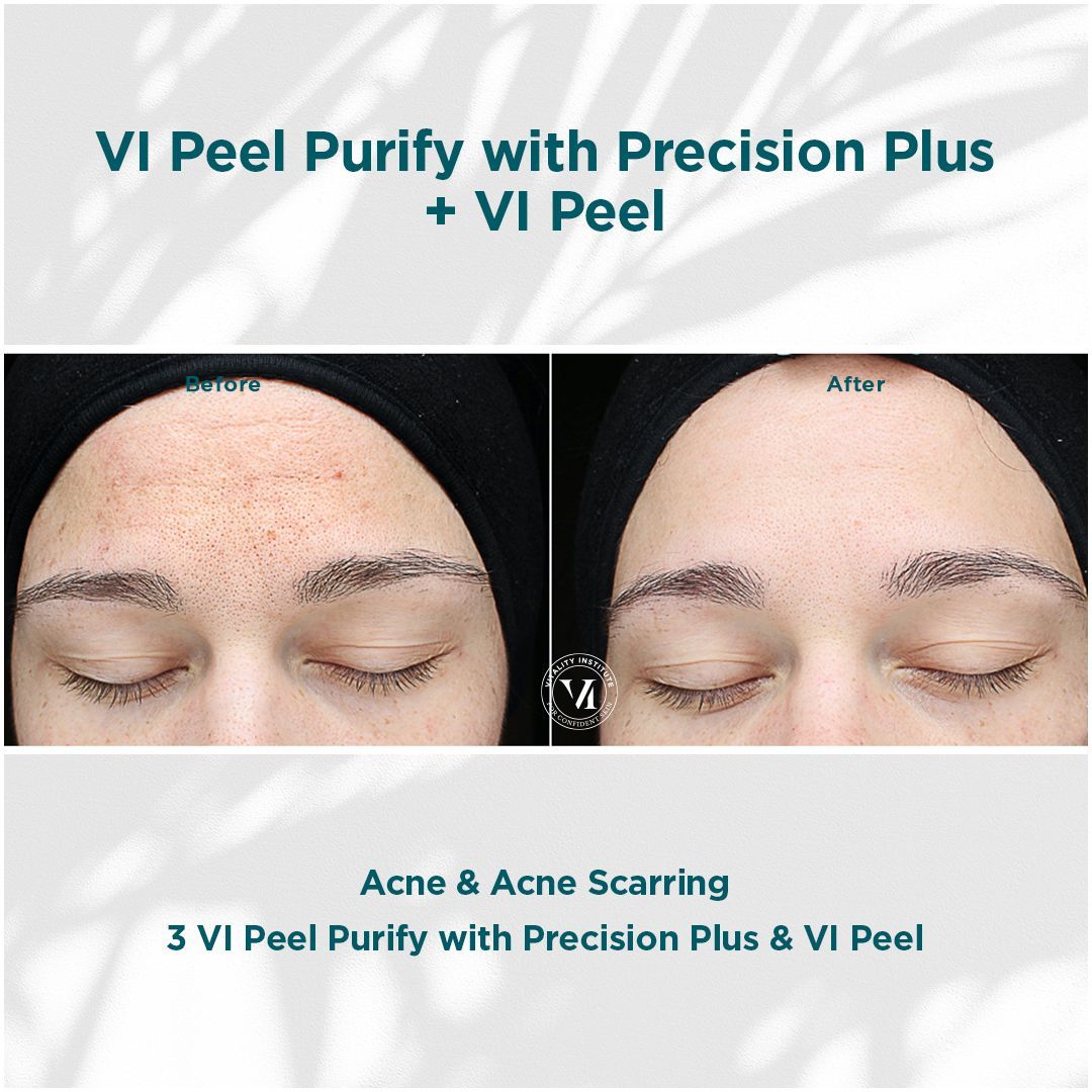 A before and after photo of a woman 's face with the words vi peel purify with precision plus + vi peel