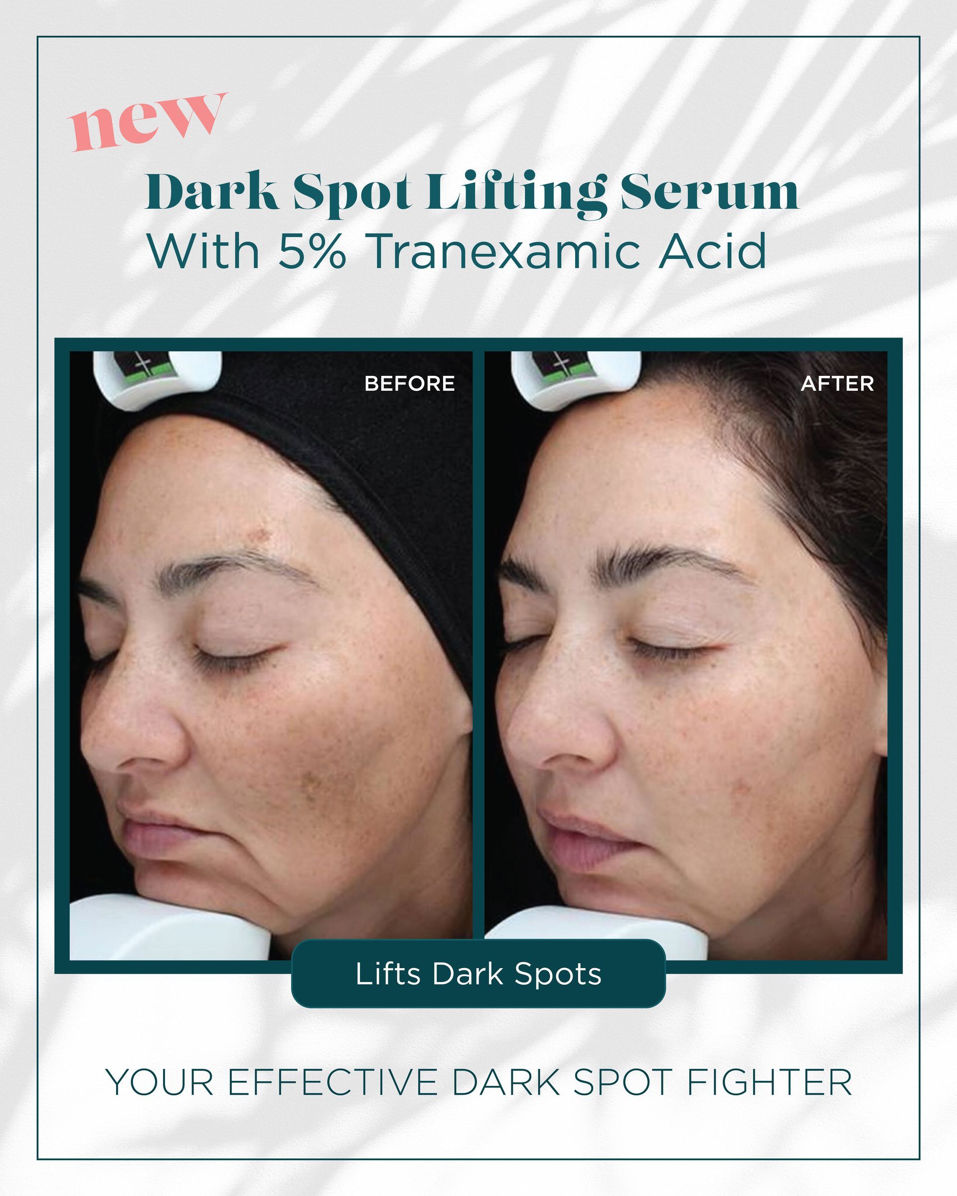 A woman 's face is shown before and after using a dark spot lifting serum with 5 % tranexamic acid.