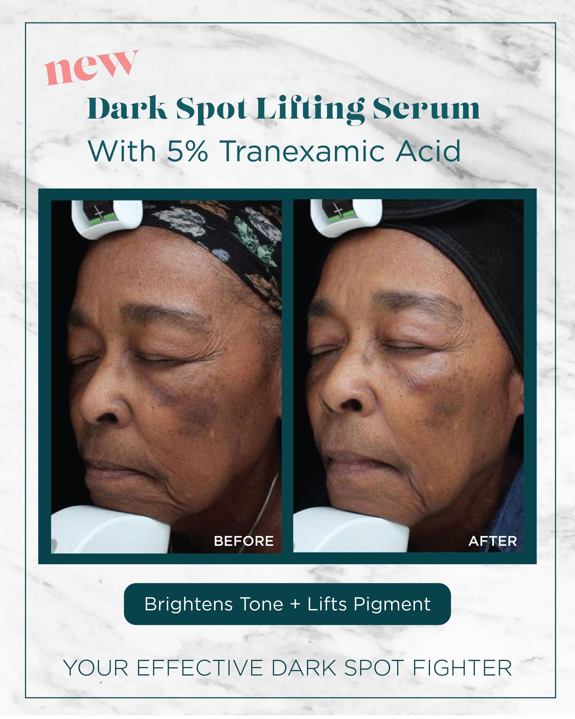 A woman 's face is shown before and after using a dark spot lifting serum