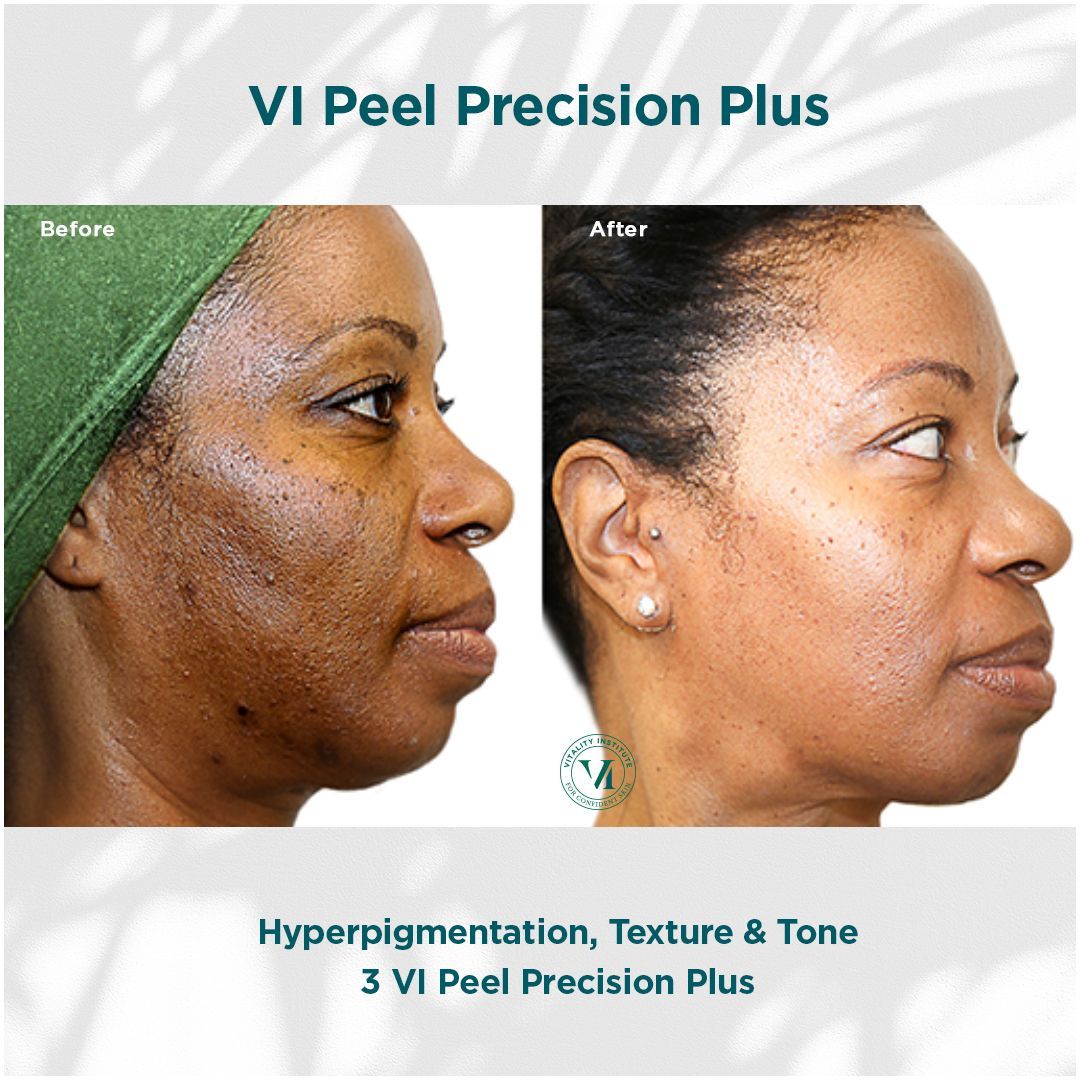 A before and after photo of a woman 's face with hyperpigmentation , texture and tone.