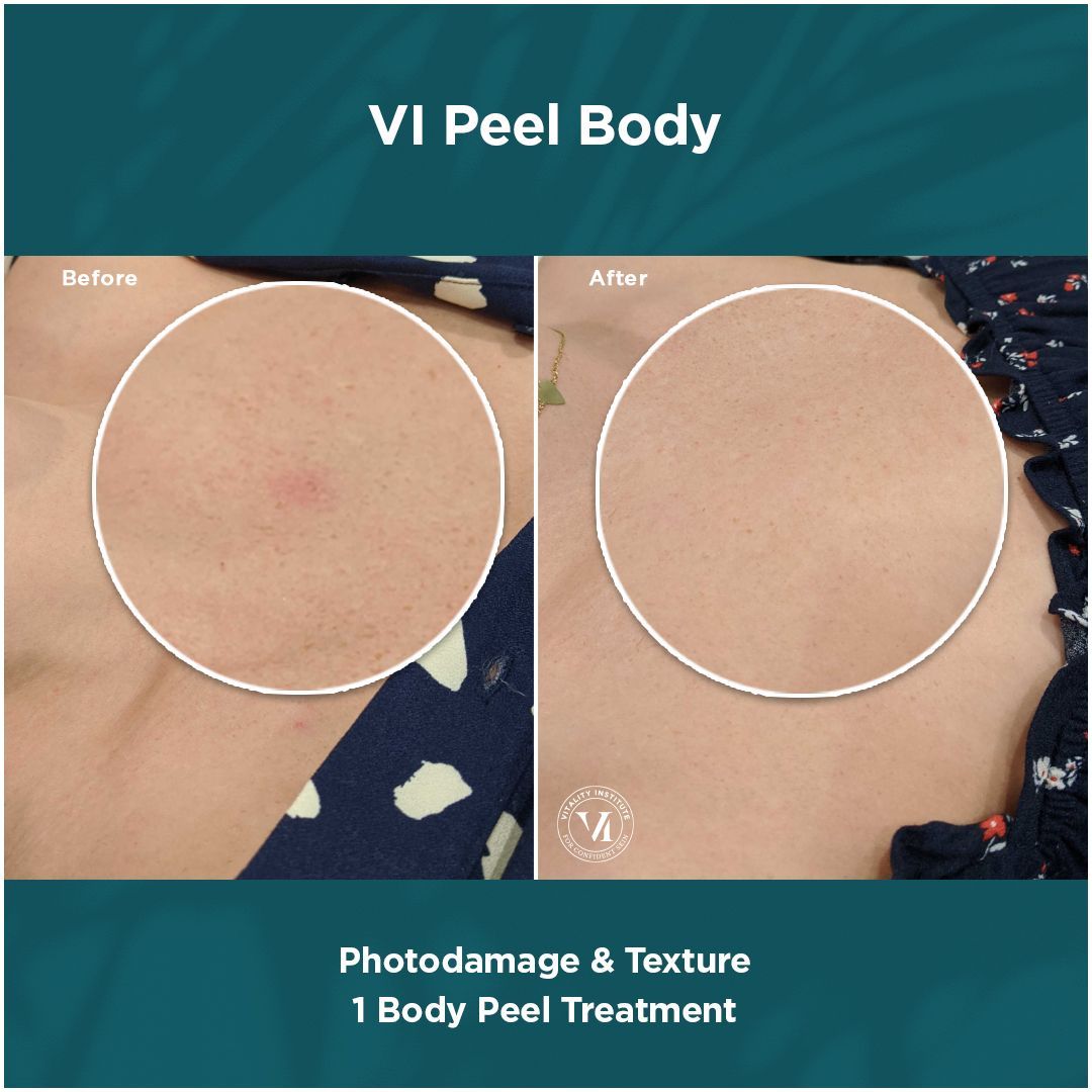 A before and after photo of a body peel treatment