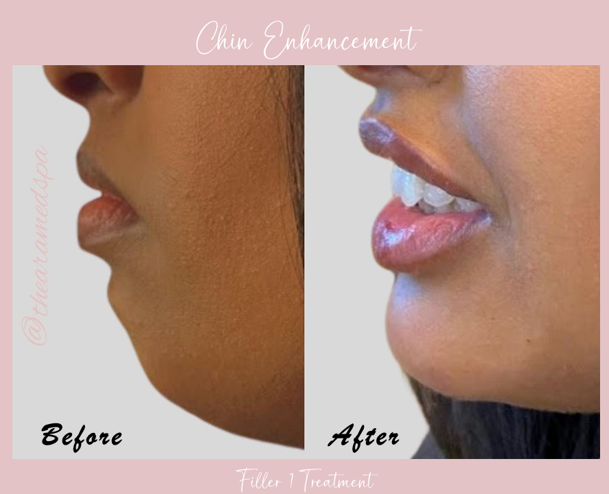 A before and after photo of a woman 's chin enhancement